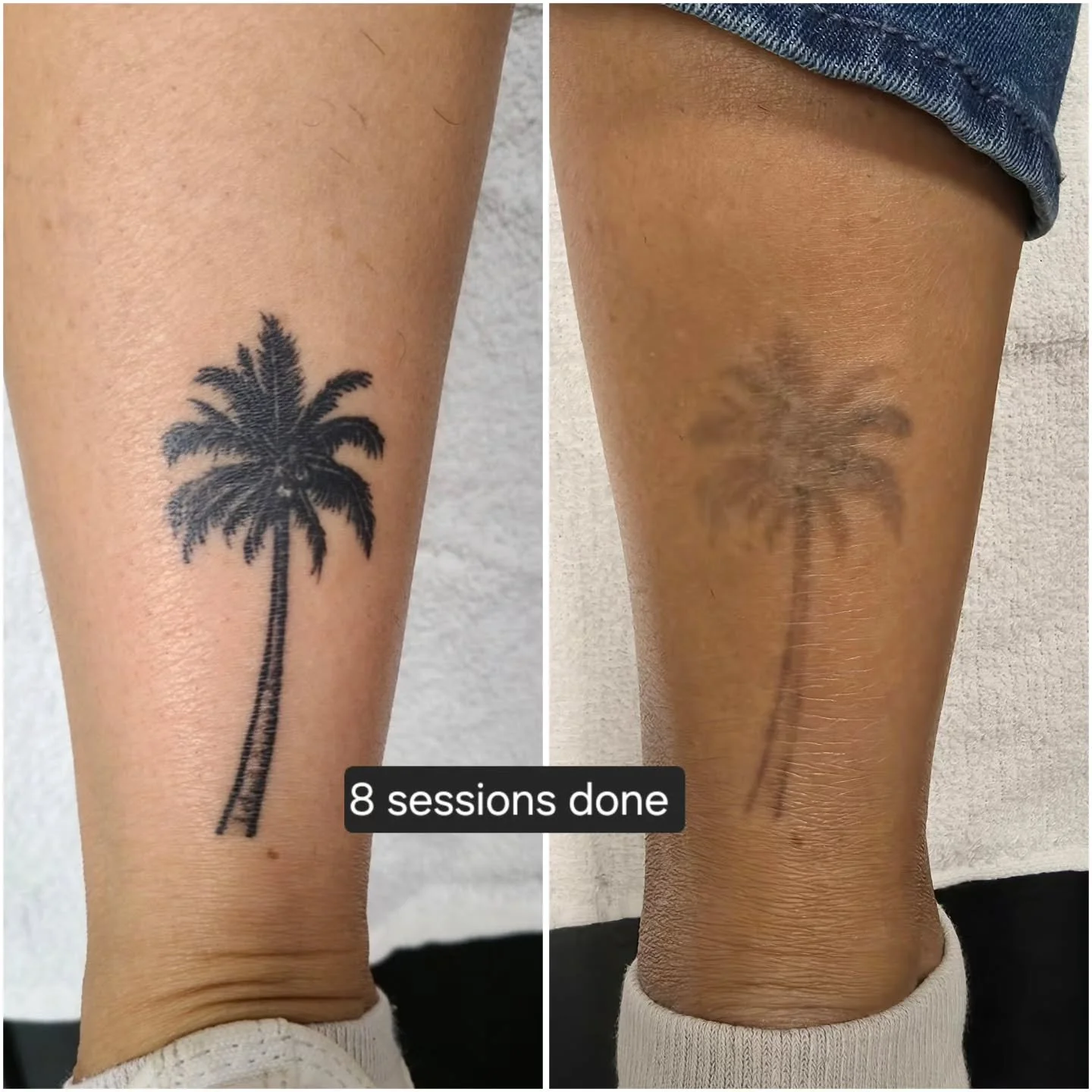 Everyone's body works differently, and results can vary depending on how strong a person's immune system is, the style/ink used, how healthy of a lifestyle a person lives...etc. the average tattoo can take 8-12 sessions to remove. 

For any questions