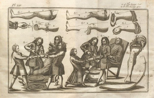 Operasjoner uten bedøvelse  – om kirurgi før narkosens tid