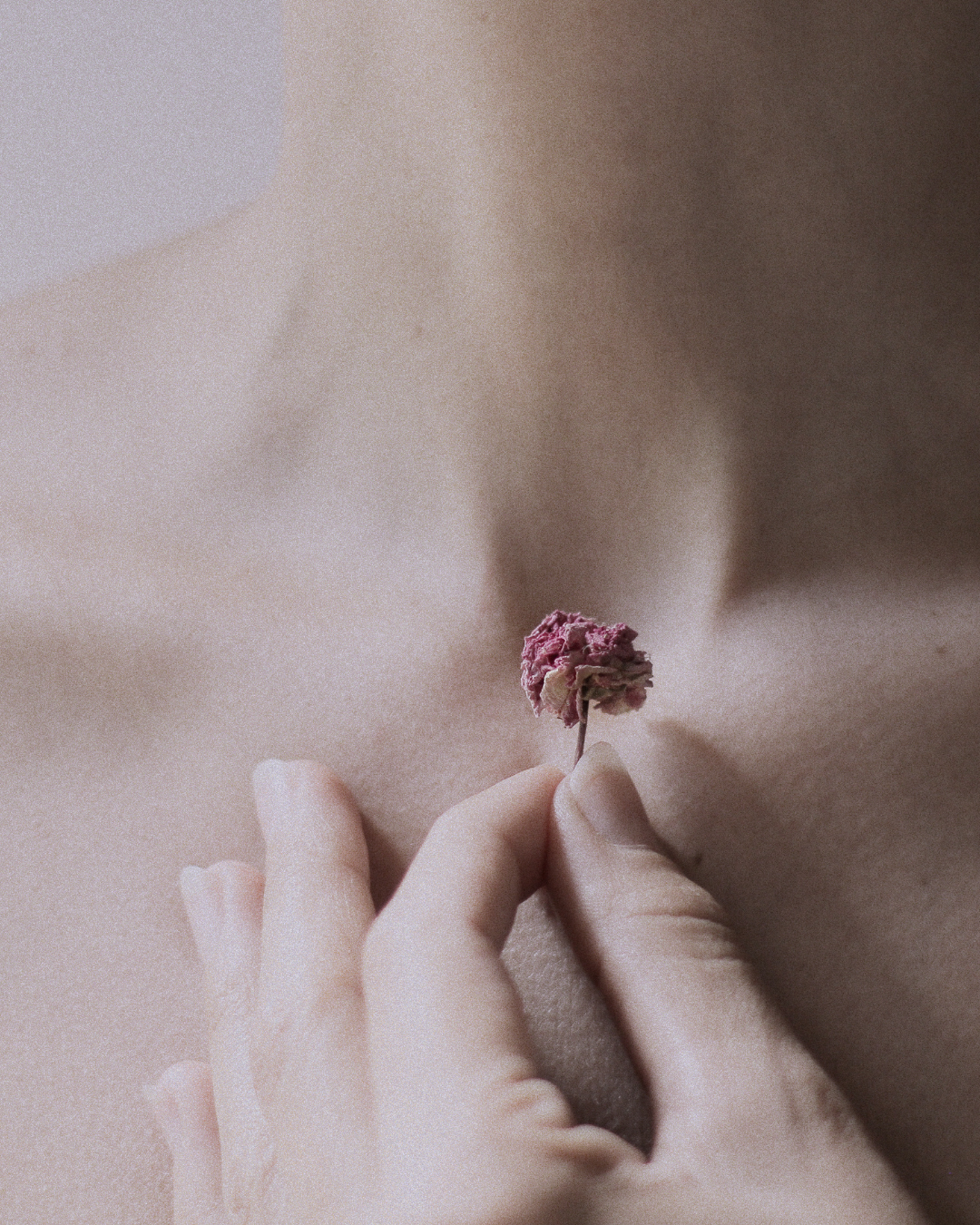 Chinese Medicine and Topical Steroid Withdrawal 