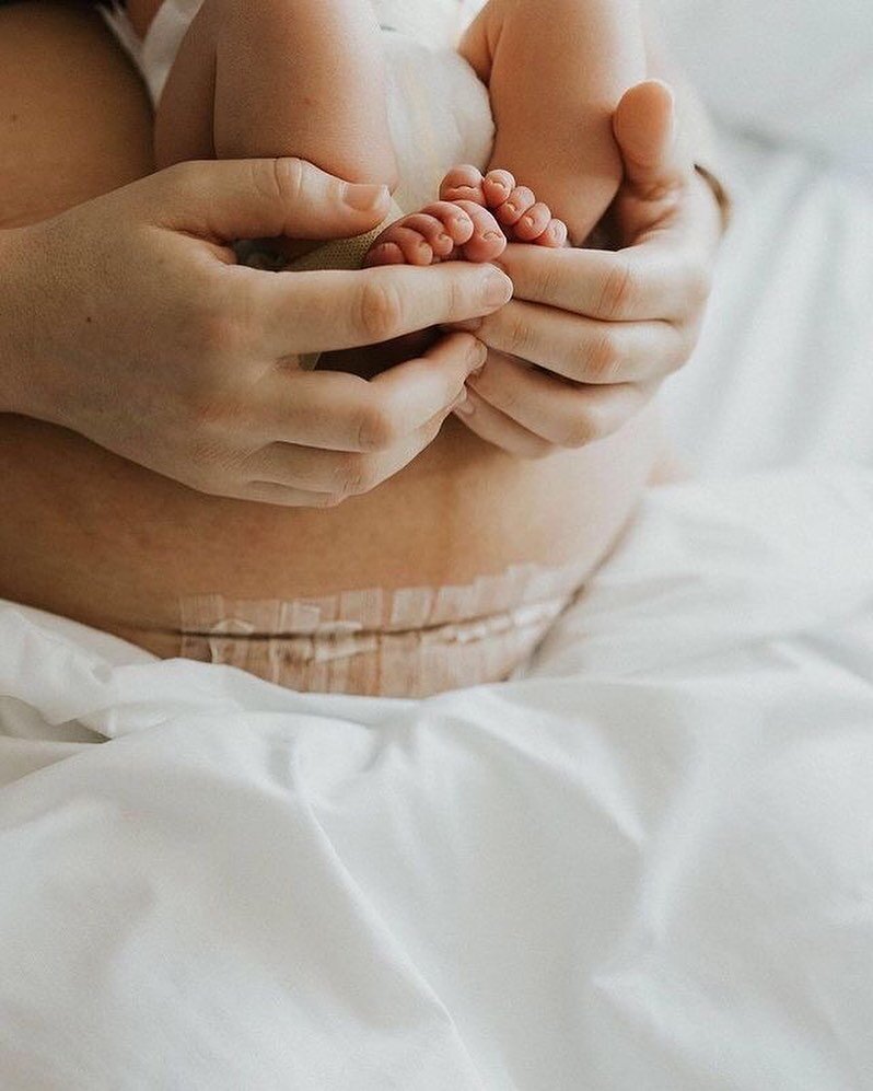 Cesarean Awareness Month 🩹
⠀⠀⠀⠀⠀⠀⠀⠀⠀
Ooff! Lots to say here as cesareans are a complex and nuanced topic in the birth world, holding a lot of &ldquo;also this&rdquo; and &ldquo;but that&rdquo; &mdash;so I&rsquo;ll try to include as much as I can to 