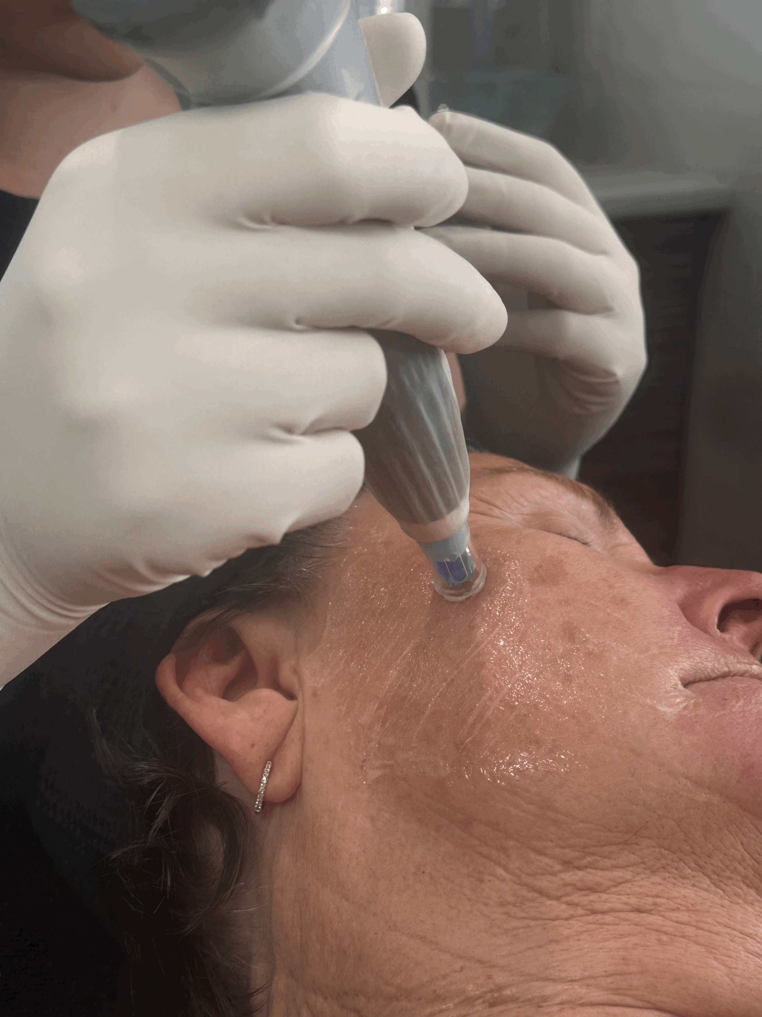 Dermapen Face & Neck Treatment