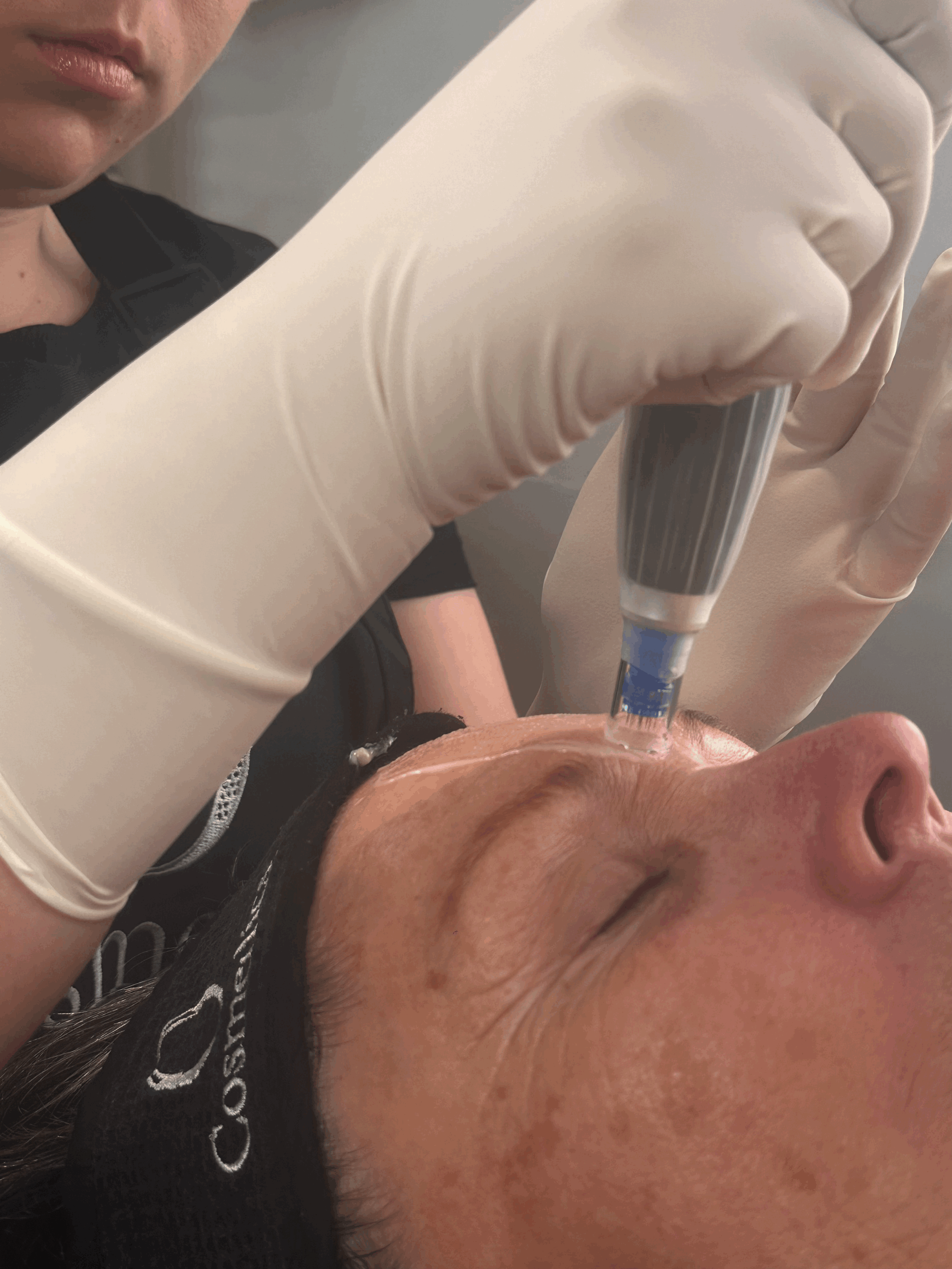 Dermapen Complete Treatment