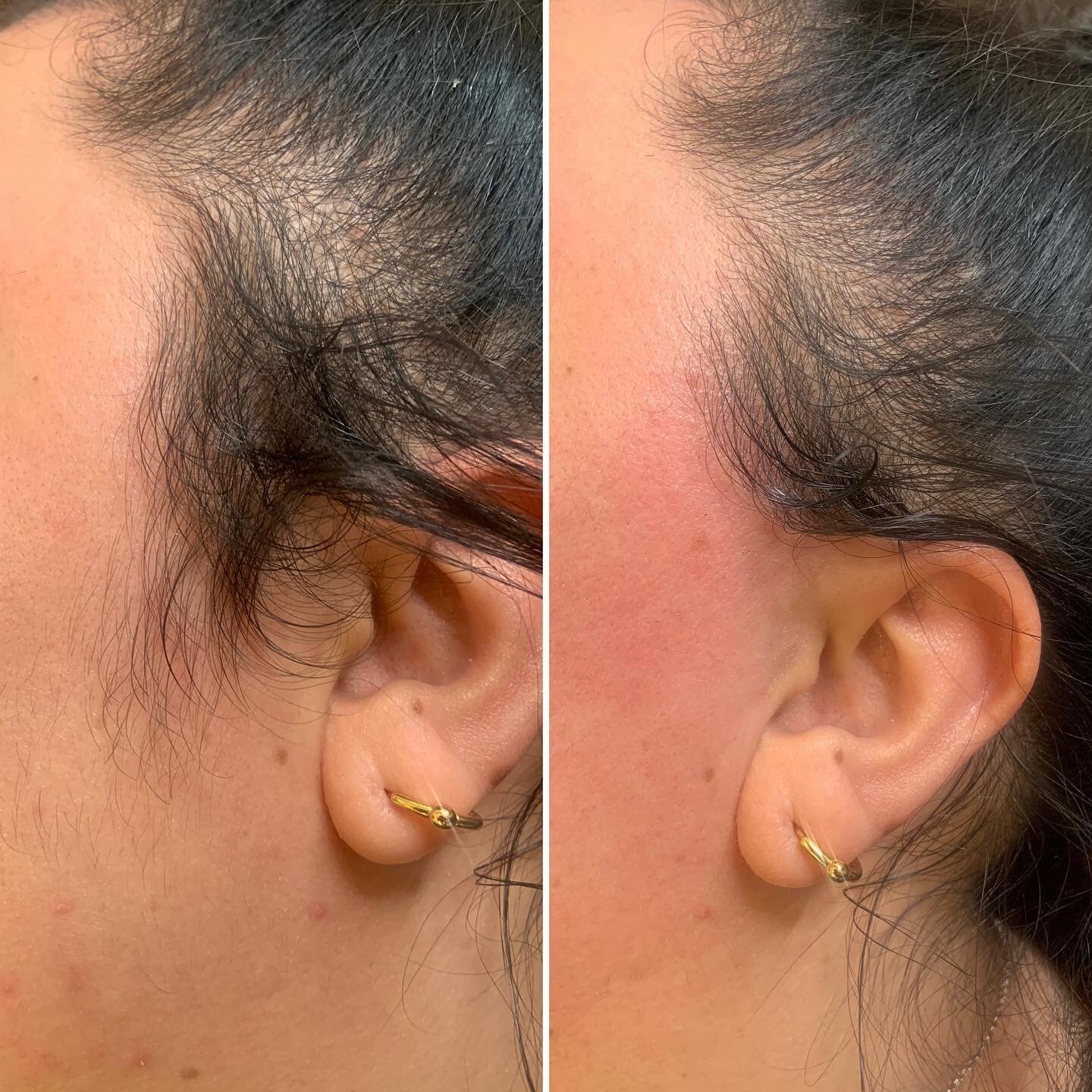 Sideburns be gone 🪄 

A simple wax can make all the difference 😍

Many clients ask:

&ldquo;Will waxed hair grow back thicker?&rdquo; 🤔

The answer is no! - the hair grows back the same and most people will find that long term waxing will result i