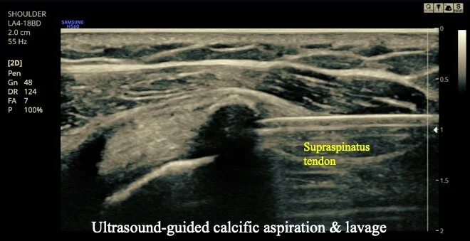 calcific-tendinopathy-dr-efren-caballes-d-o