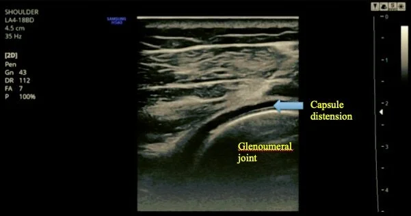 Us Guided Gh Inj US Procedures Overview — Dr. Efren Caballes, D.O.