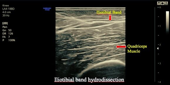 ITB Iliotibial Band Syndrome - Cioffredi & Associates