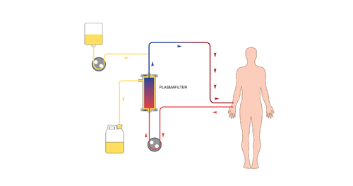 Plasma Exchange Plasmapheresis Benefits and Procedure