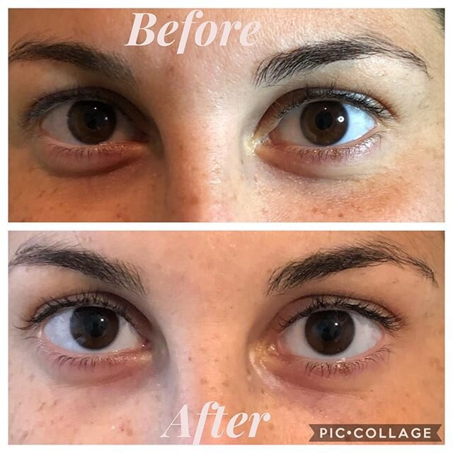 ▫️If it makes you feel beautiful, then why not?▫️
-
Natural under eye dermal filler touch up.
- 
Filler in this area can last 18-24 months.
-
Results include looking more refreshed, less tired, and more youthful.