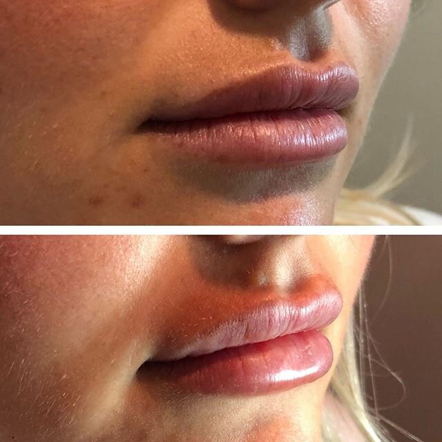 ▫️LIP FILLER▫️
-
Dermal lip fillers can be quite subtle to a juicy plump depending on what you want as well as what will look best to balance to your other features. It is a very customized treatment. The type of filler, amount, as well as injection 