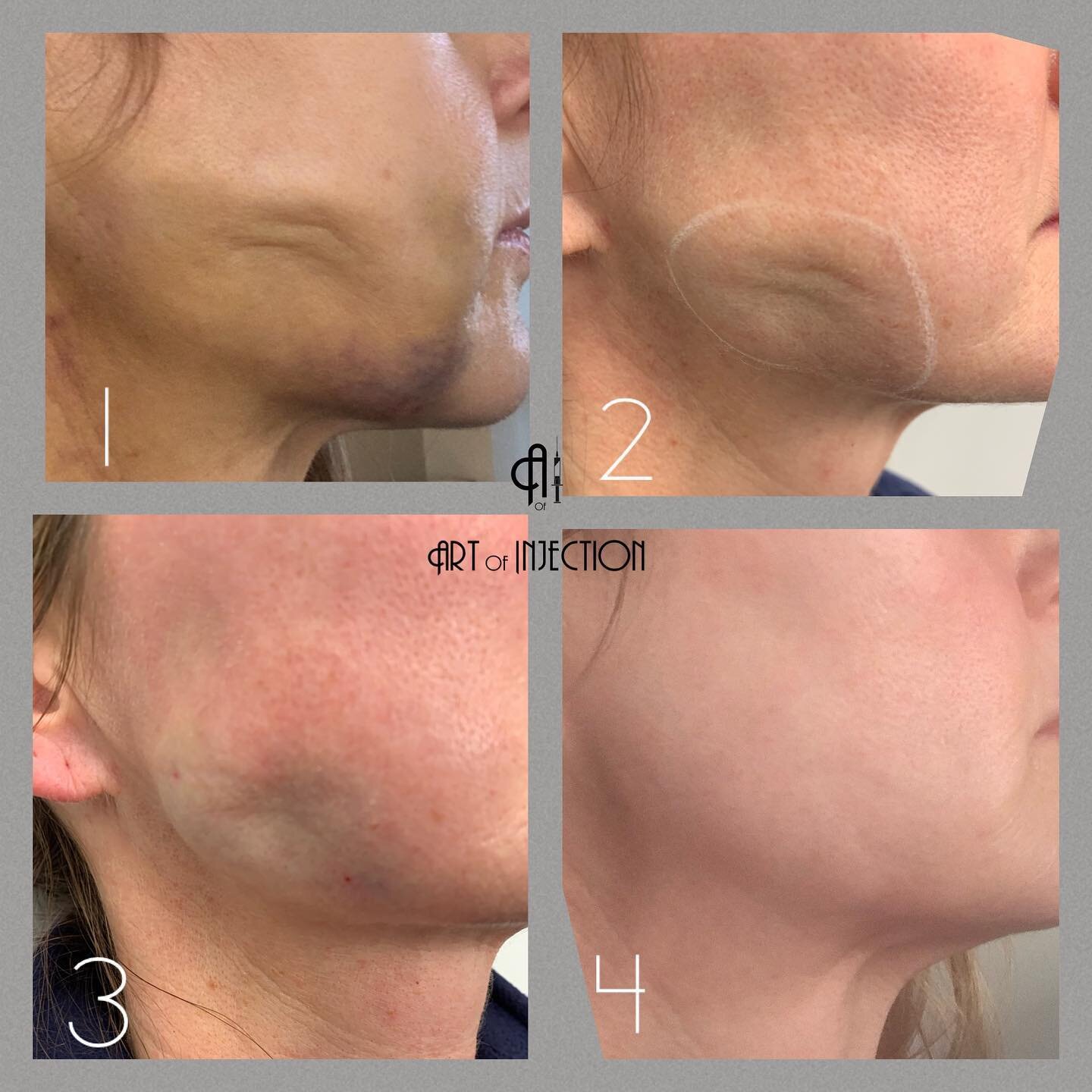 Injectables for scar tissue revision??
𝕪𝕖𝕤! 𝕚𝕥 𝕔𝕒𝕟 𝕓𝕖 𝕕𝕠𝕟𝕖.
.
.
This patient came to see me after being treated with laser liposuction at another practice. She was left with dense scar tissue, indentations and some volume deficit. 
It d
