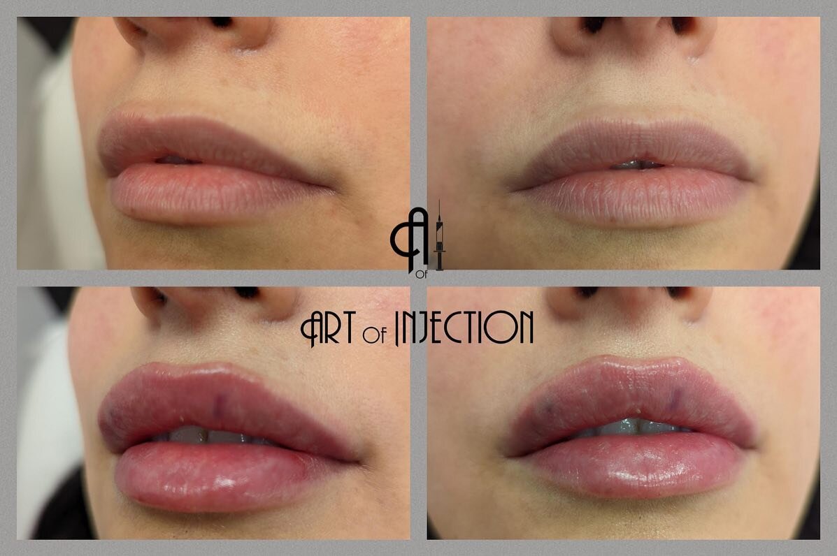 This was a unique situation. This beautiful lady had her lips done a while back with another provider and wanted to refill but with a different shape. 

𝕨𝕖 𝕕𝕖𝕔𝕚𝕕𝕖𝕕 𝕥𝕠 𝕕𝕚𝕤𝕤𝕠𝕝𝕧𝕖, 𝕣𝕖𝕗𝕚𝕝𝕝, 𝕒𝕟𝕕 𝕣𝕖𝕤𝕙𝕒𝕡𝕖 

She had a very d