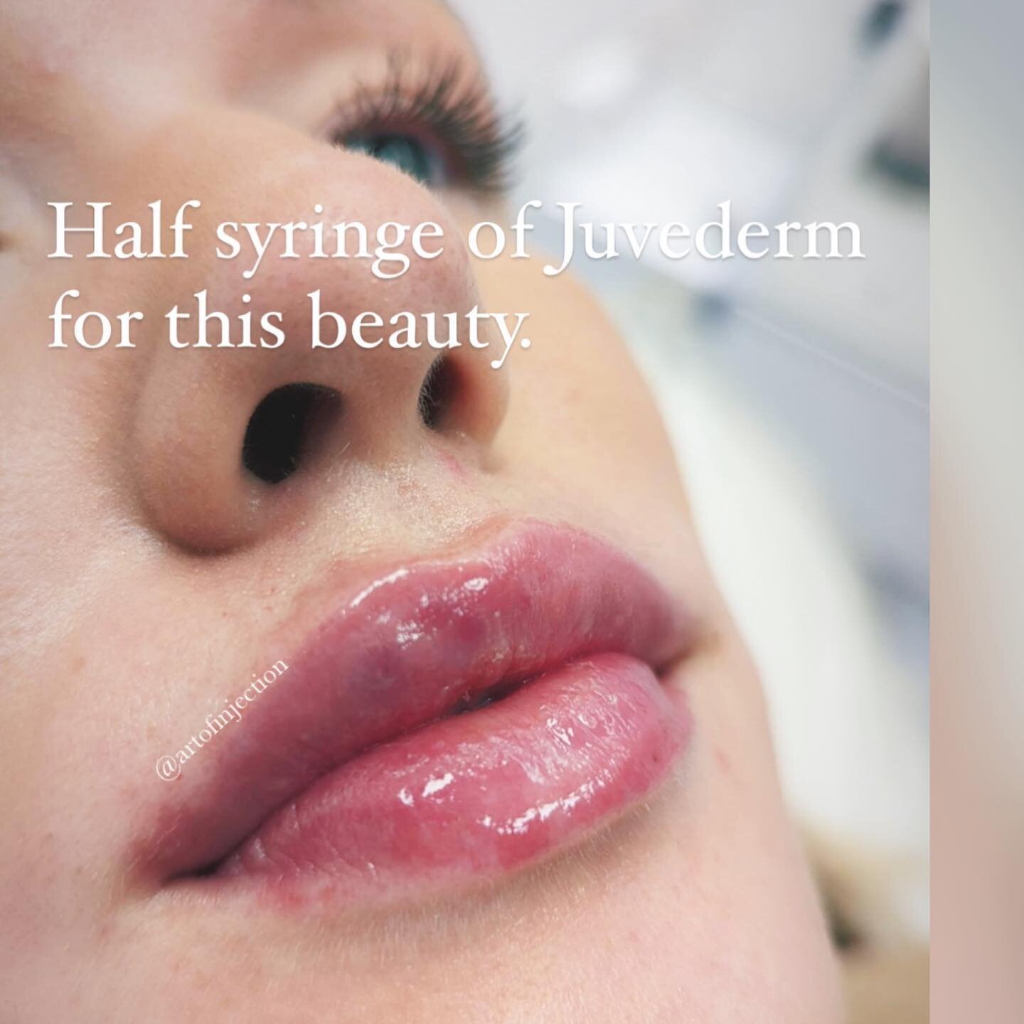 These lips were made for Kissing 💋
.
.
.

#lipfiller #juvederm #lipinjections #juvedermlips #restylane #cosmeticinjectables #juvedermultra #lipenhancement #facialaesthetics #kissablelips #galderma #lipaugmentation #cosmeticinjections #perfectpout #a