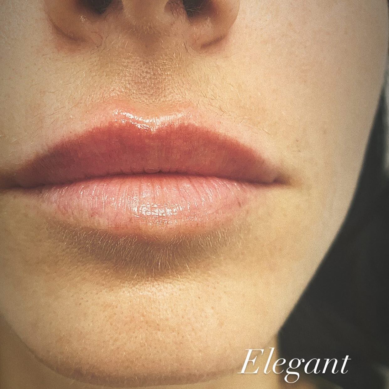 Lip filler can be subtle, elegant&hellip; 
.
.
.
#lipfiller #lipaugmentation #bestlipfillers #lipsofinstagram #lipinjections #aestheticinjector #beauty #artofinjection