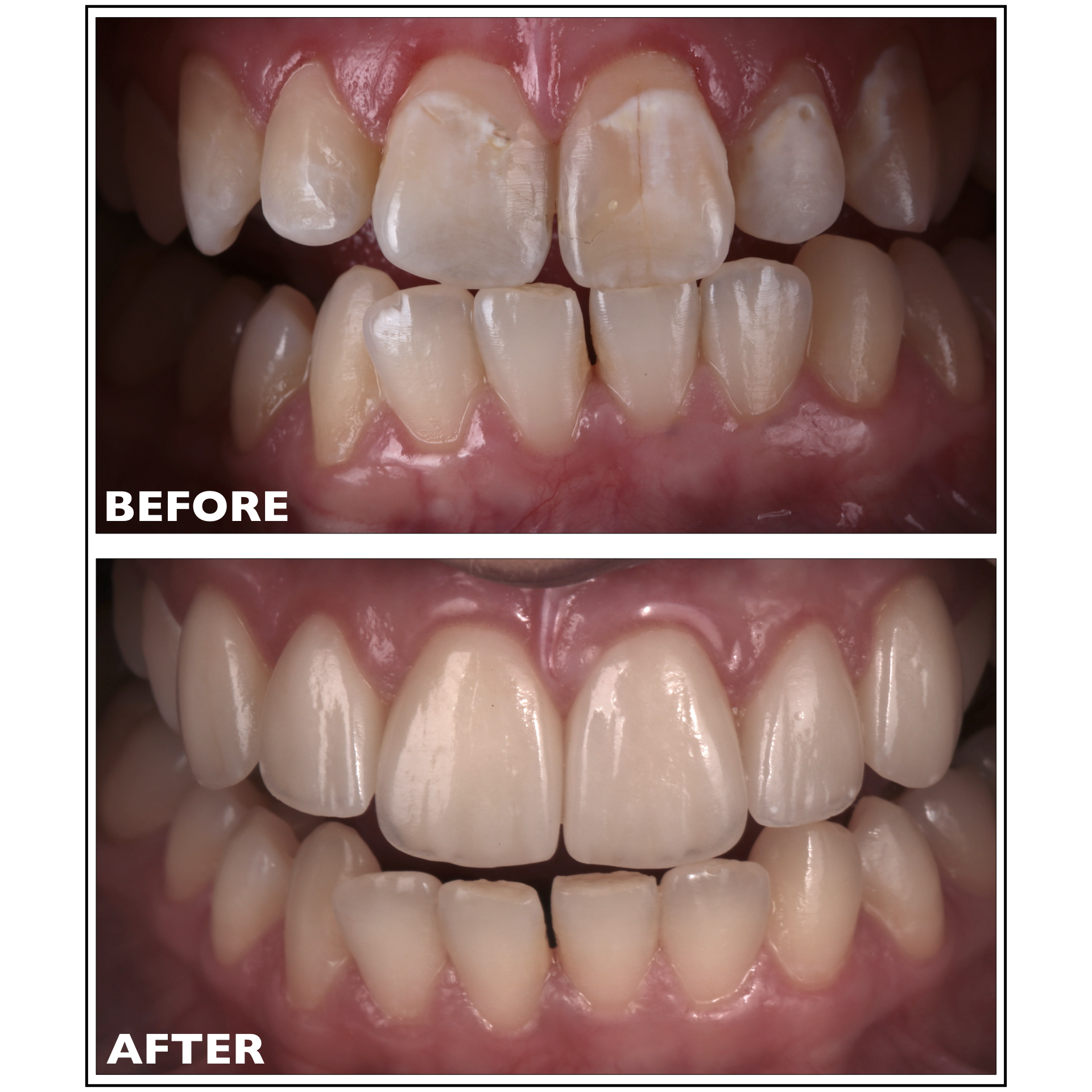 Dental Treatments, Portland, Maine Before and After