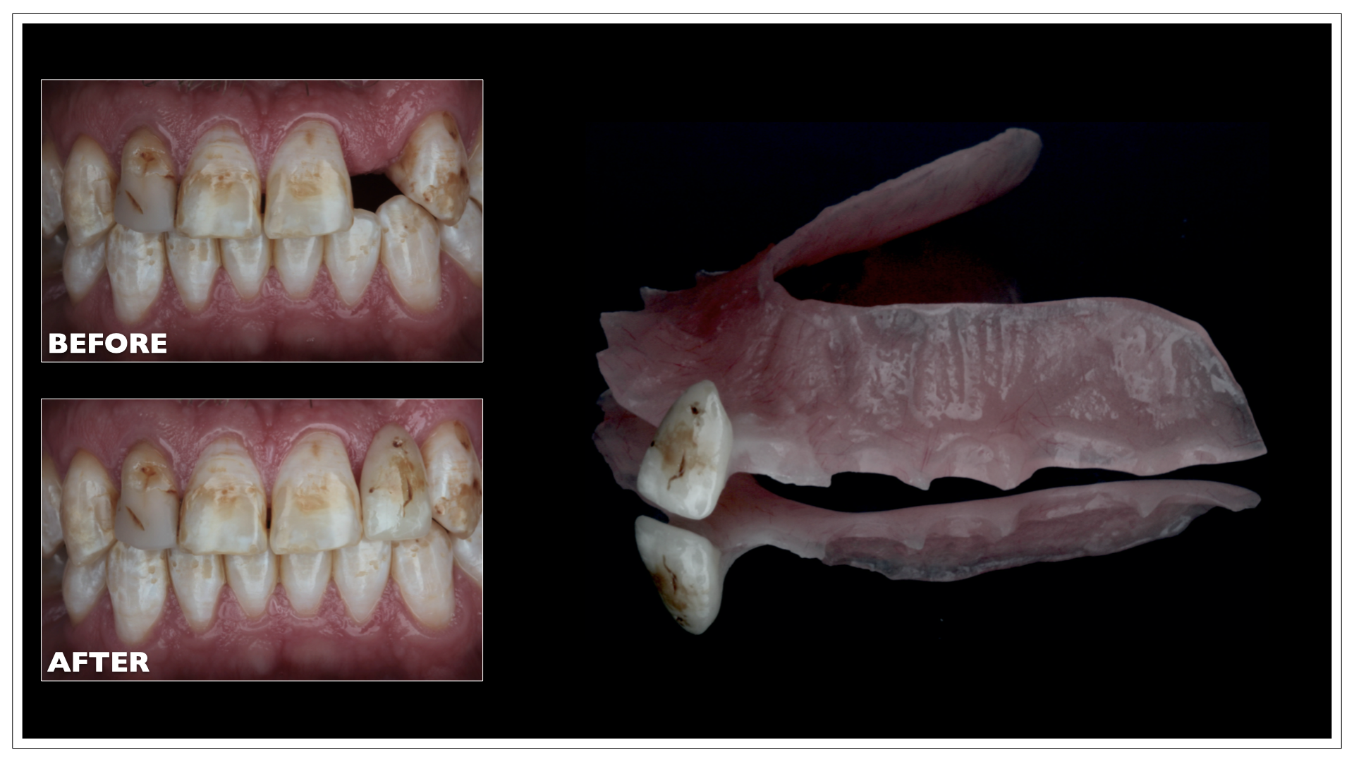 Partial Dentures Portland, Maine Nuance Dental