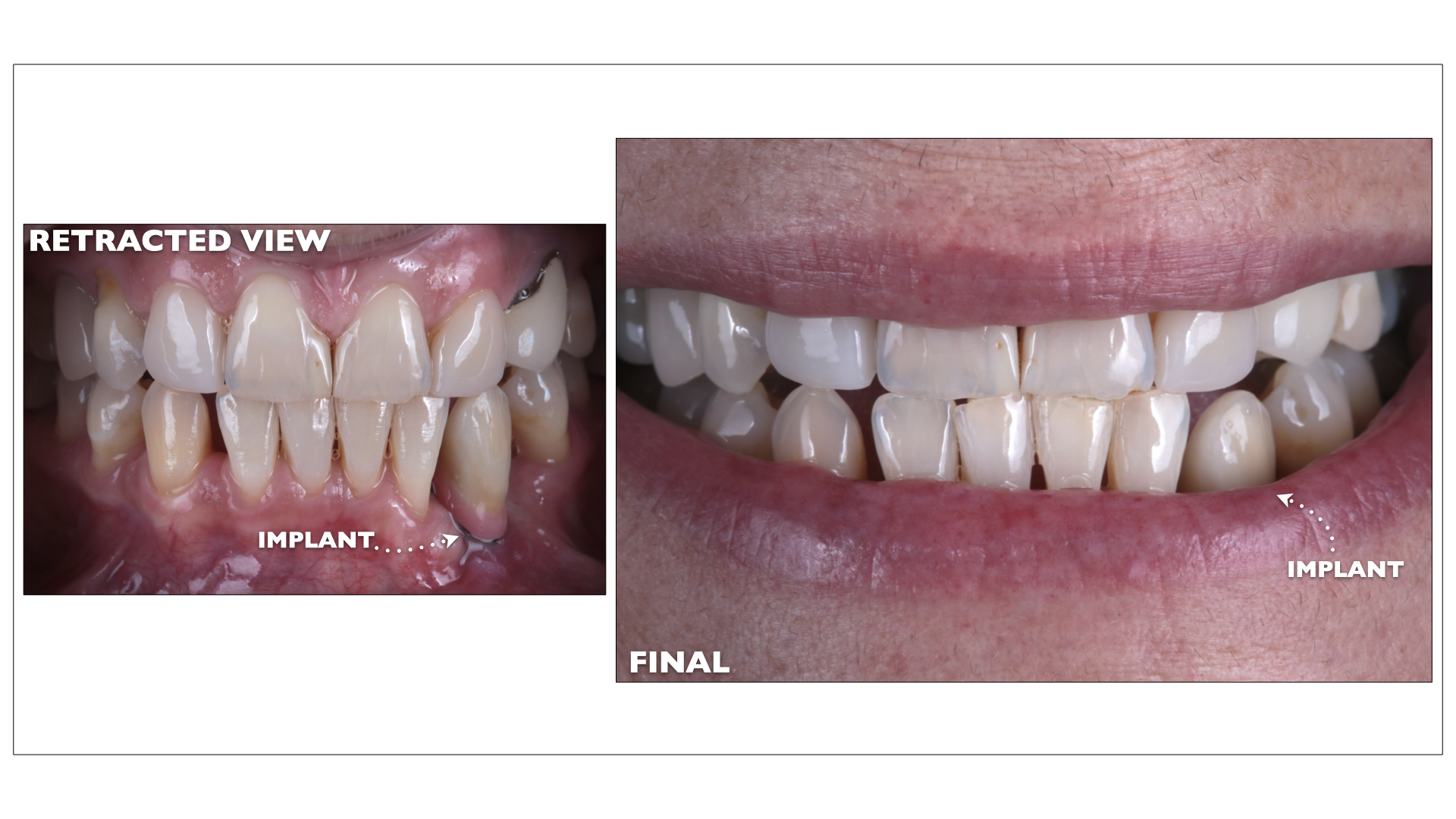 Dental Implants Portland, Maine Nuance Dental