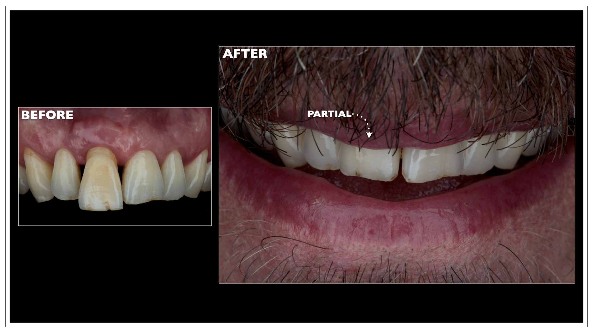 Partial Dentures Portland, Maine Nuance Dental