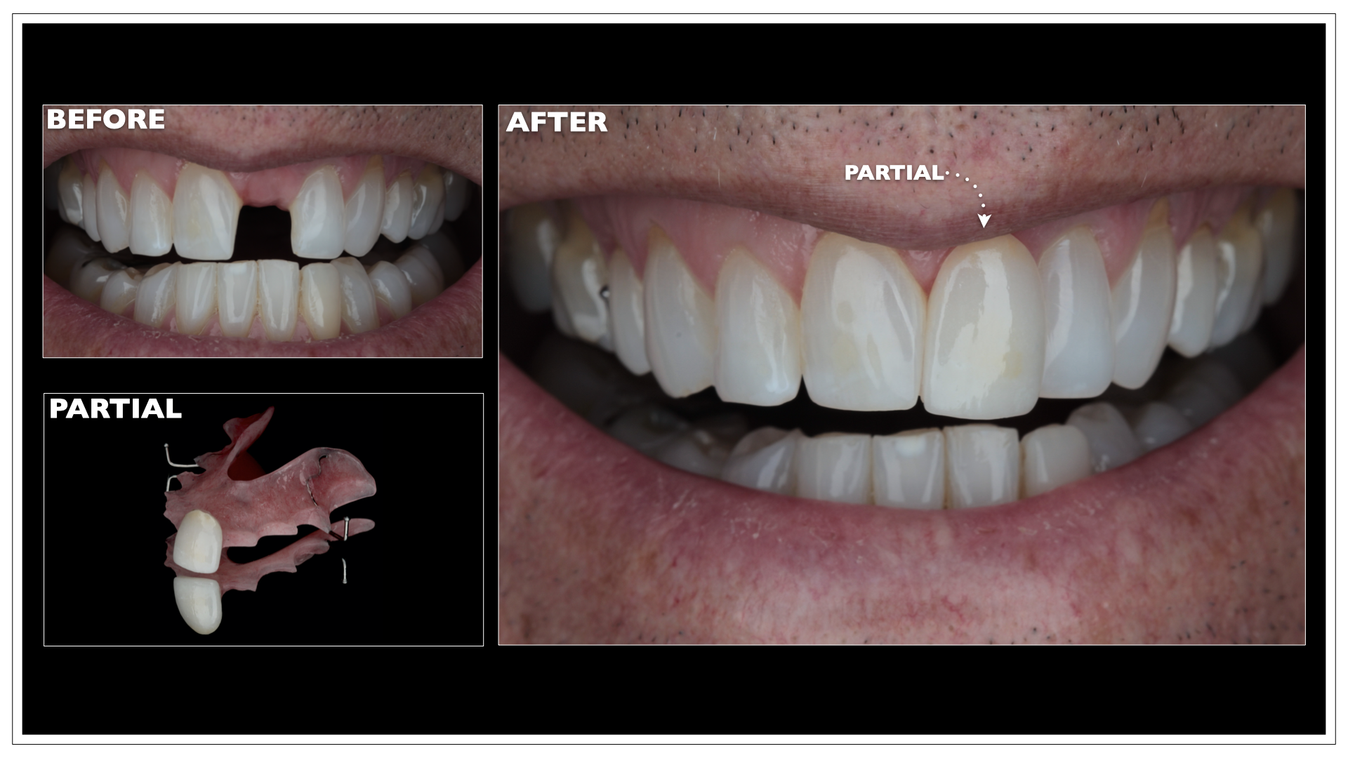 Partial Dentures Portland, Maine Nuance Dental