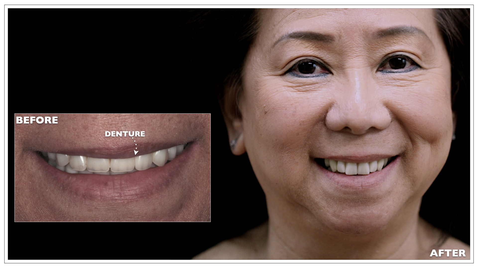 Cosmetic Dentures Portland, Maine Nuance Dental