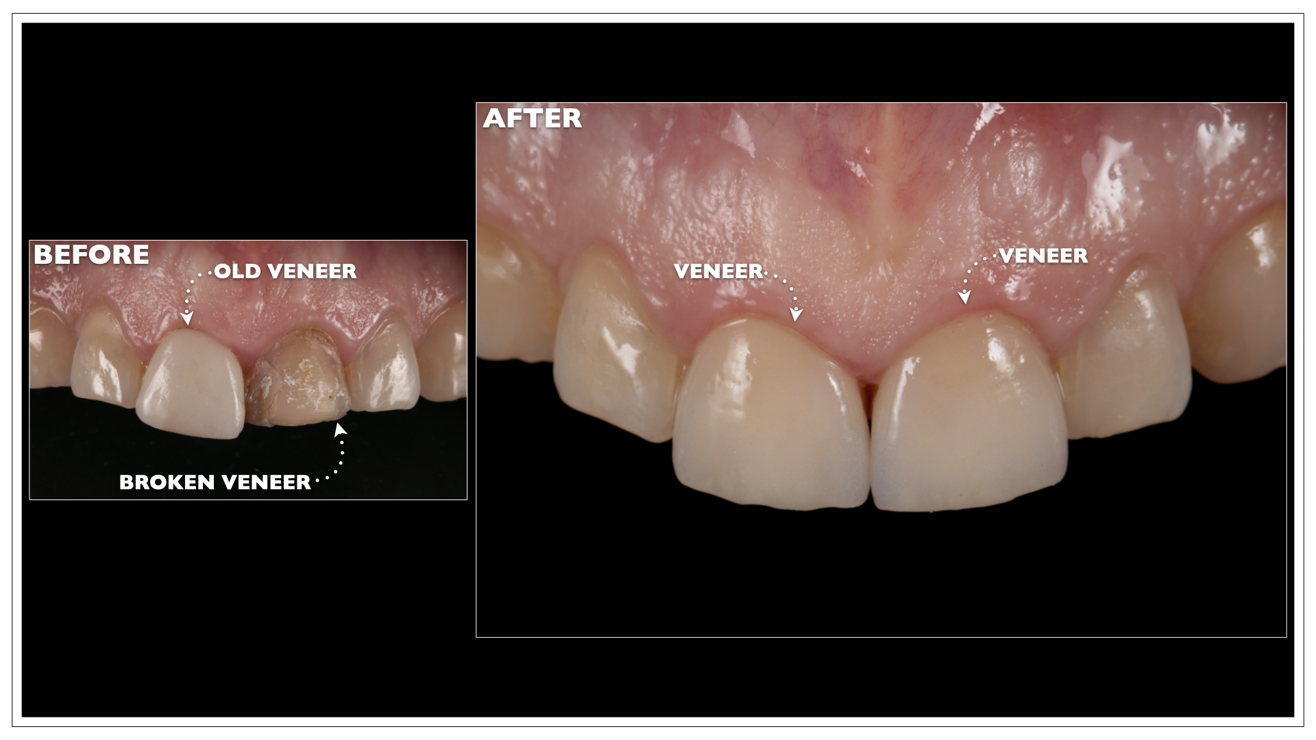 Porcelain Veneers Portland, Maine Nuance