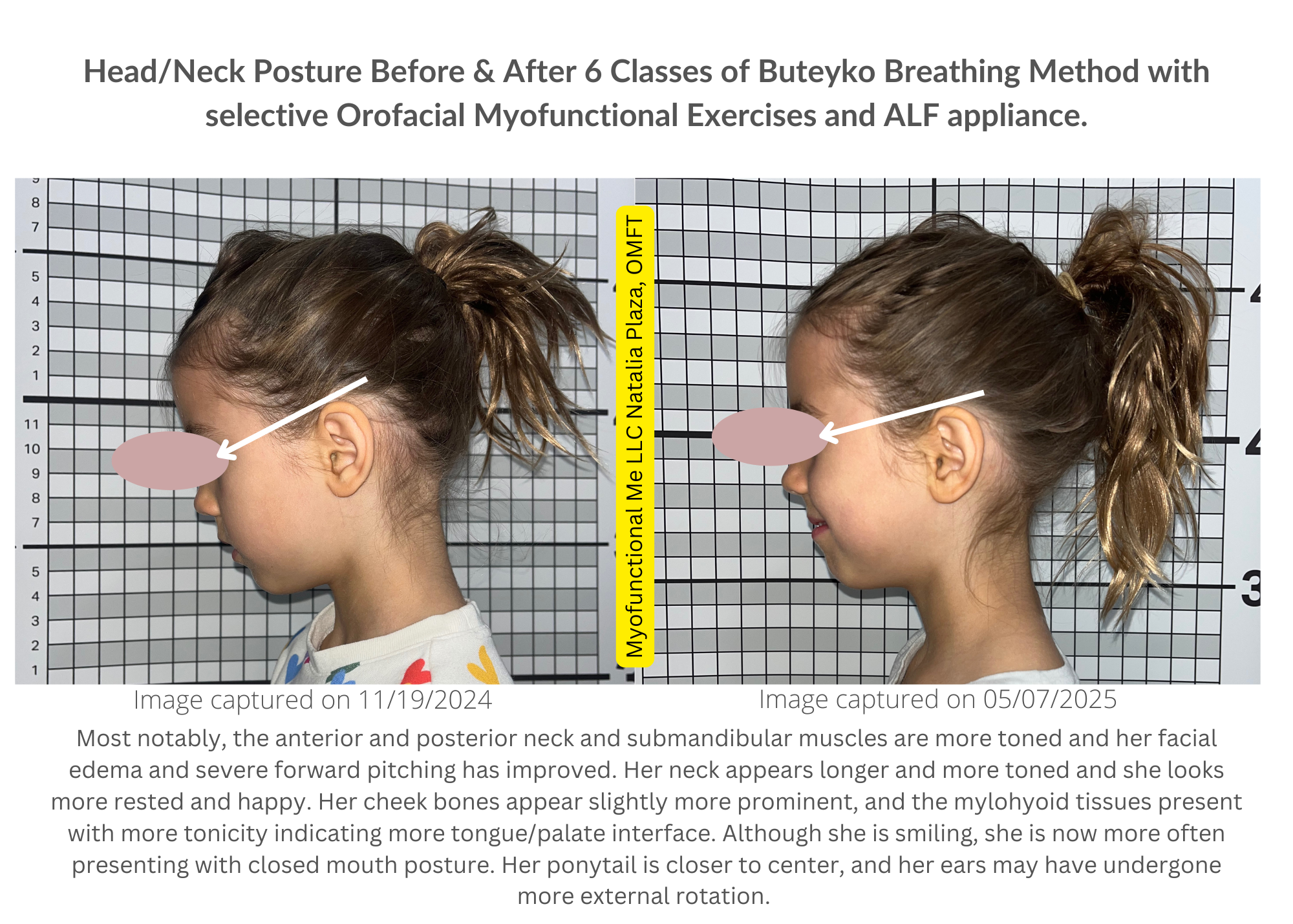 Luca G headneck Before & After Buteyko (1).png