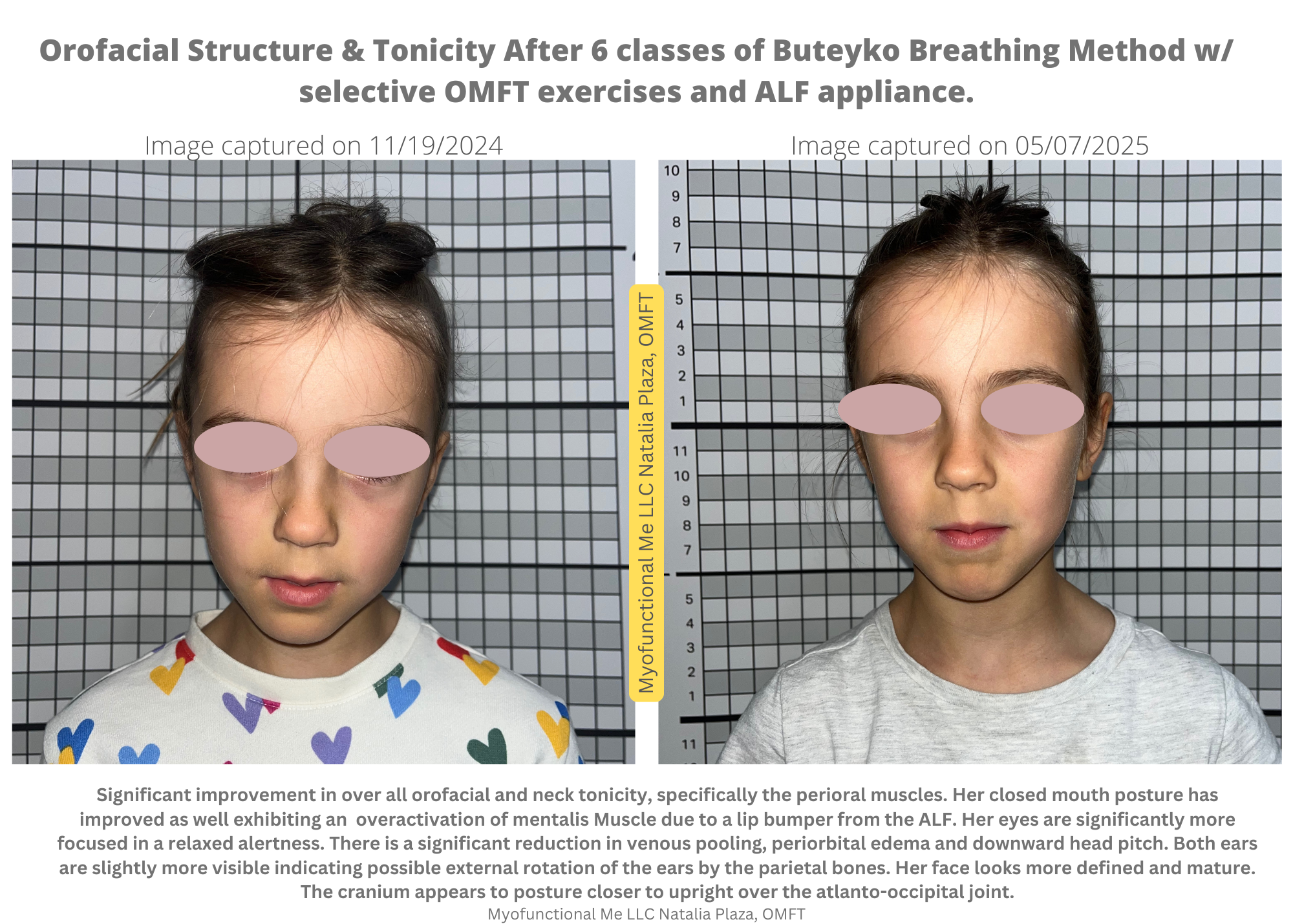 Luca G Craniofacial features before & after Buteyko.png