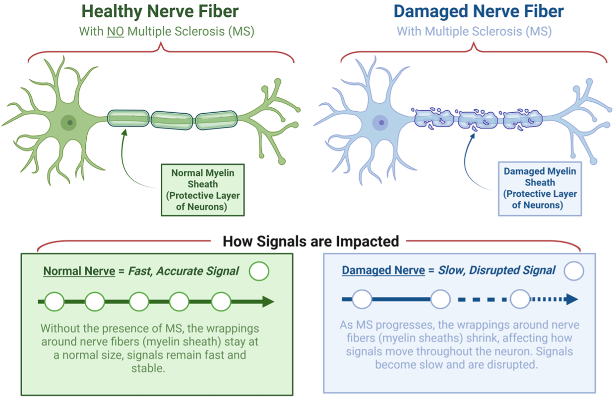 When Shrinkage Isn't What It Seems: How a Common Steroid Treatment May Be Changing the Way We Track MS