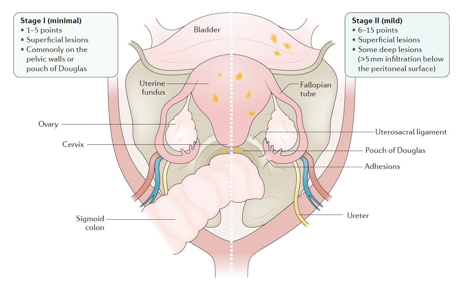 Stage 1-2 Pelvic endometriosis. Endometriosis, Nature Reviews Disease Primer, 2018, Vol 4(1) pp.9
