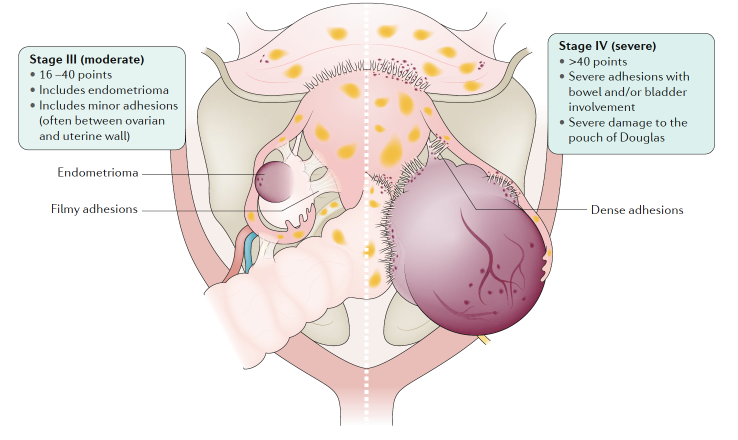 Stage 3-4 Pelvic endometriosis. Endometriosis, Nature Reviews Disease Primer, 2018, Vol 4(1) pp.9