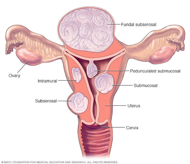 Location of fibroids within the uterus