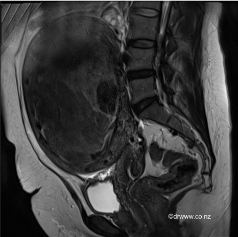 MRI image of a large 15cm fibroid that was managed with a Laparoscopic Myomectomy&nbsp;