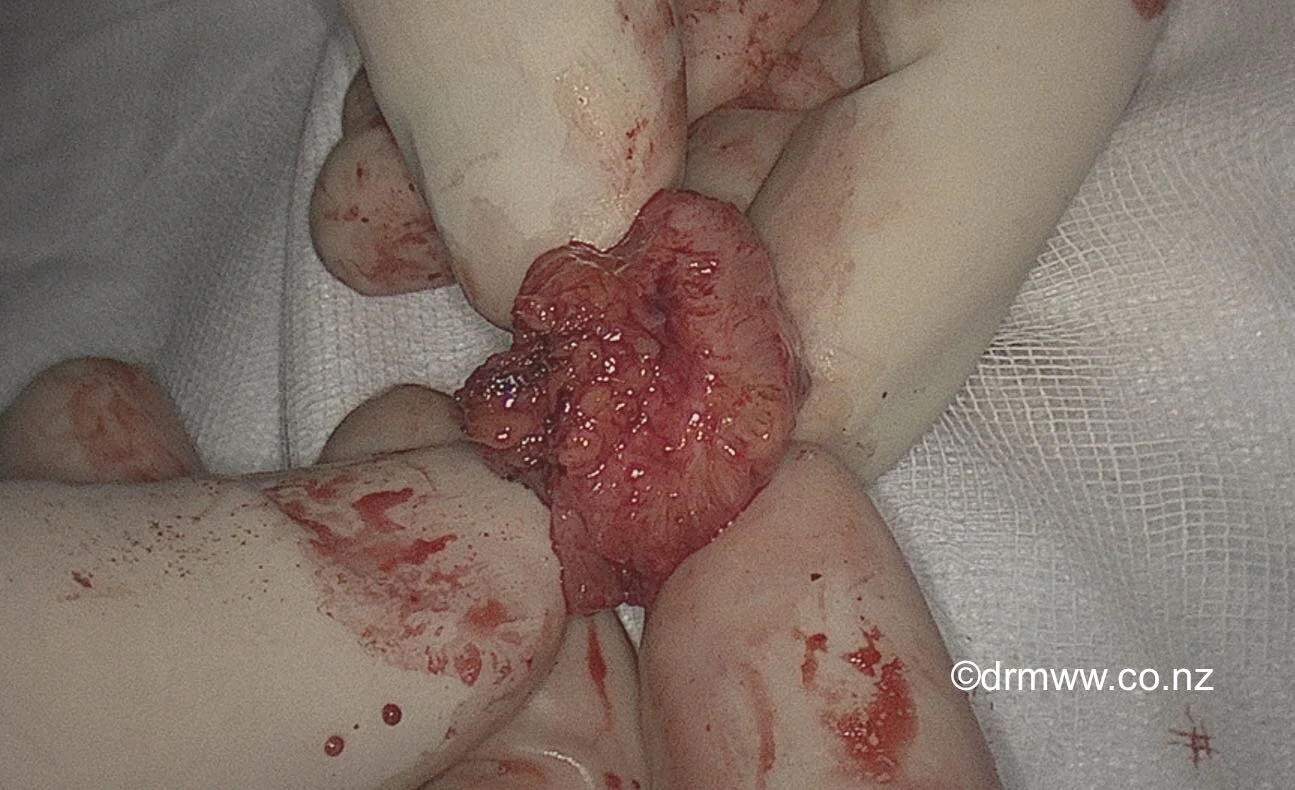A rectal muscularis lesion after laparoscopic shaving