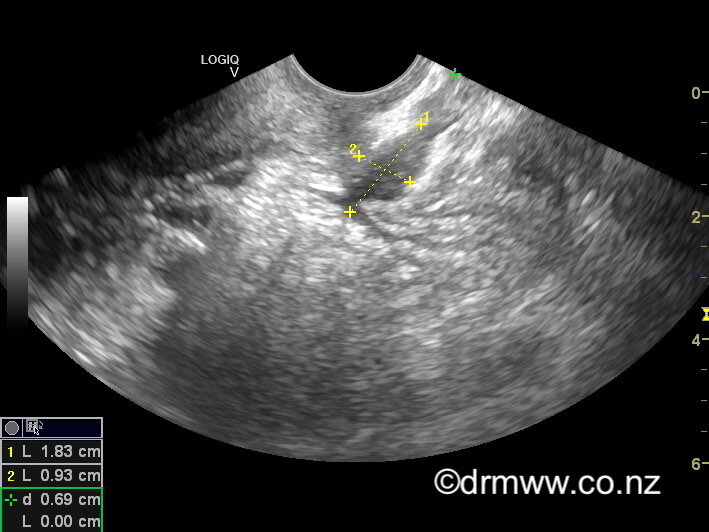 A rectal muscularis endometriosis lesion seen on TVUS