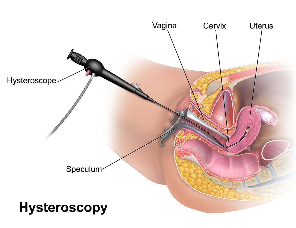 Hysteroscopy.png