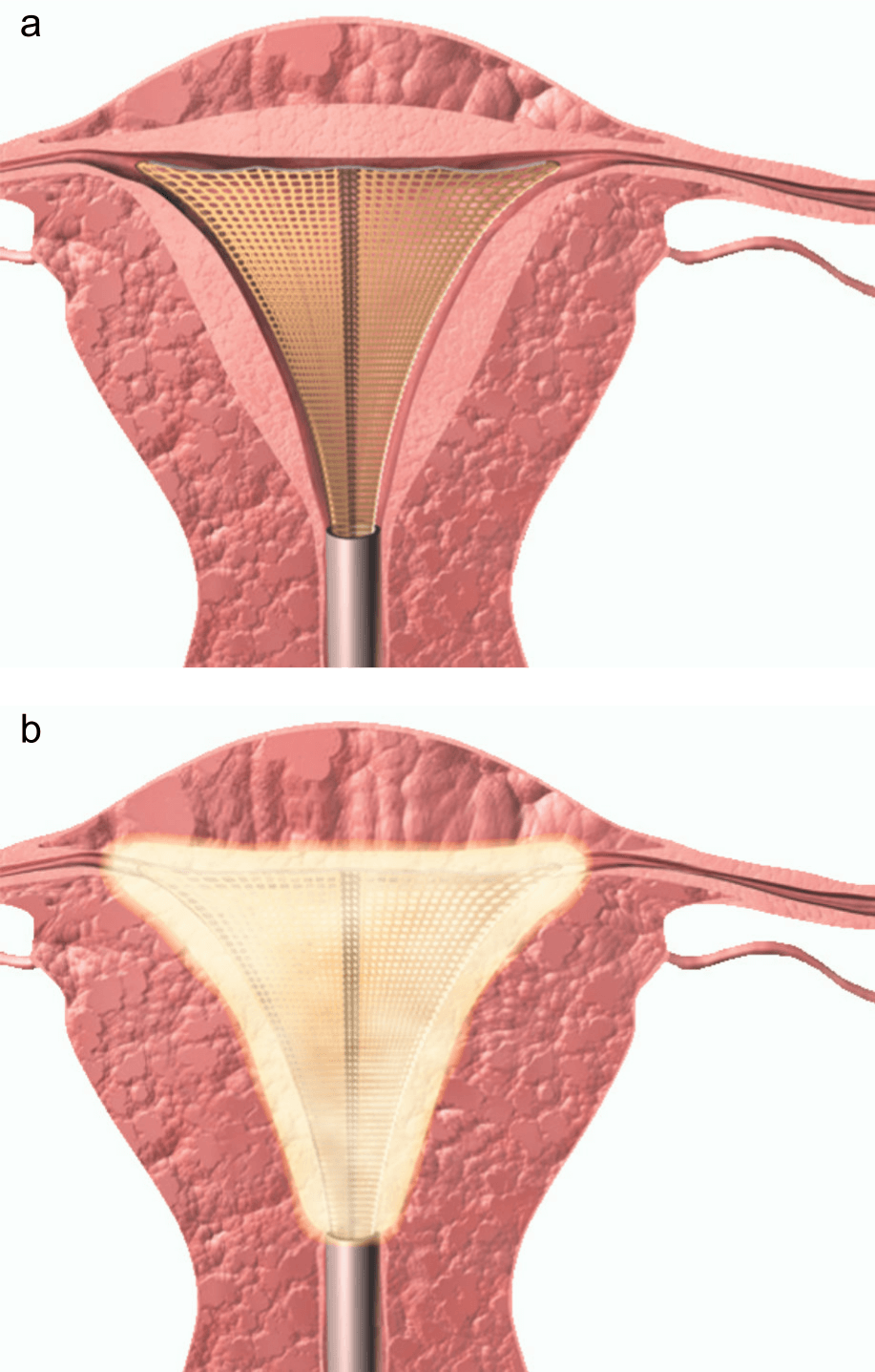 a. Novasure device is placed snuggly with the uterine cavity.  b. The device is activated and burns the active endometrium.