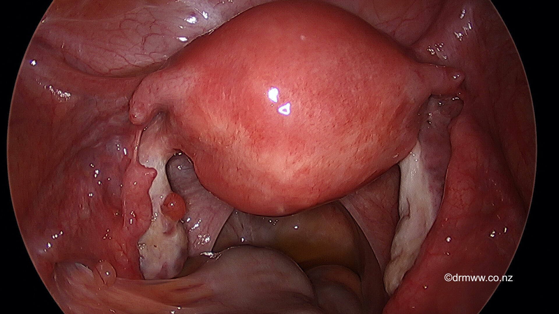 Lararoscopic view of previous tubal ligation (divided Fallopian Tubes)