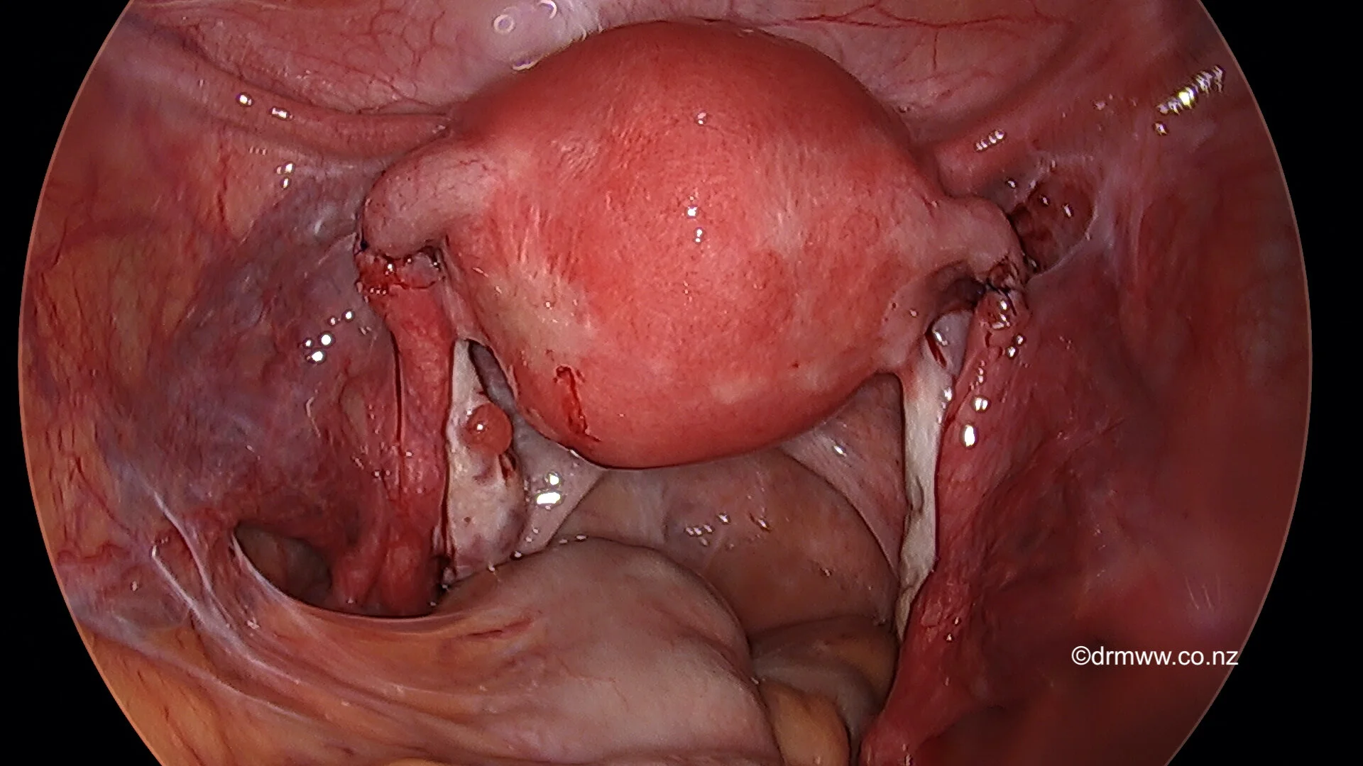 The Fallopian Tubes are rejoined after the Laparoscopic repair