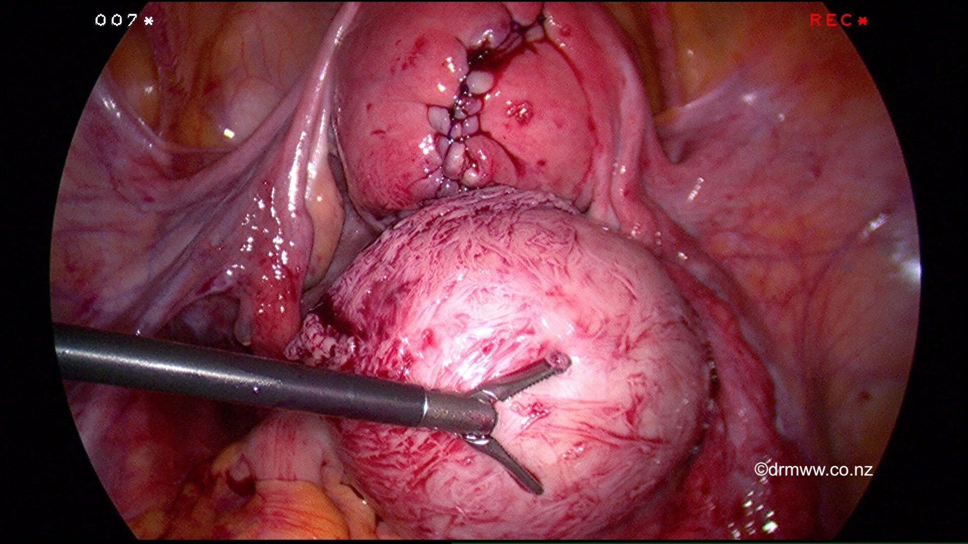 A repaired uterus and the fibroid that was removed laparoscopically.