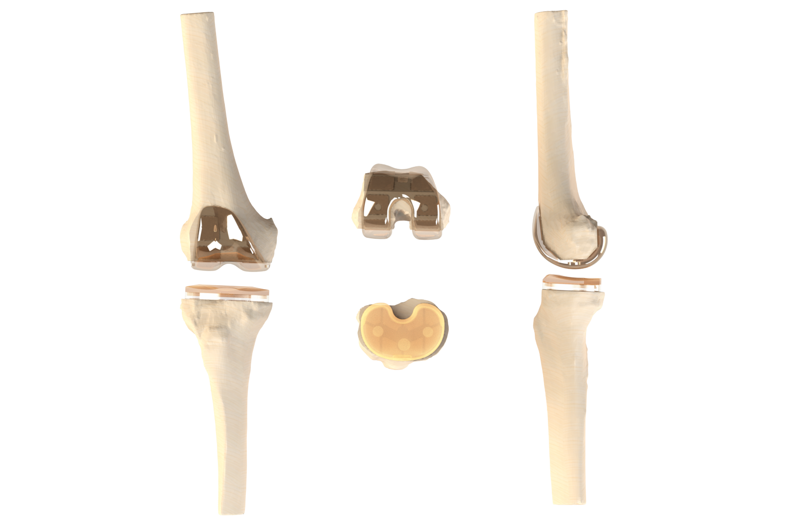 Applied Orthopedic Design Nano Knee, Knee Replacement — AOD Applied