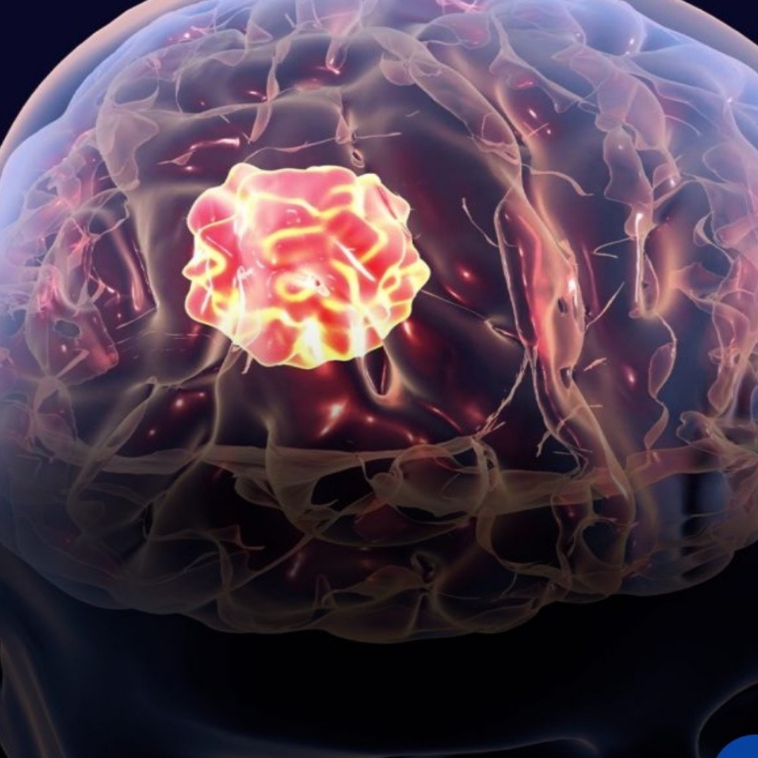 Nuevo tratamiento contra tumores cerebrales logra eliminarlos por completo