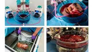 Se confirma el éxito del almacenamiento de hígado: Todo después de un año del trasplante