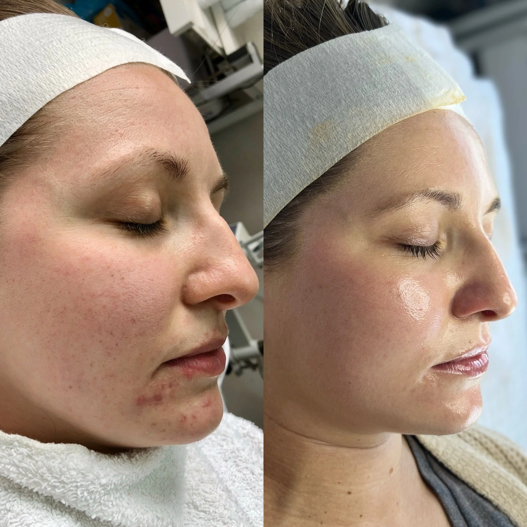 Before and after acne healing journey with certified Face Reality acne specialist in Wayzata, MN.