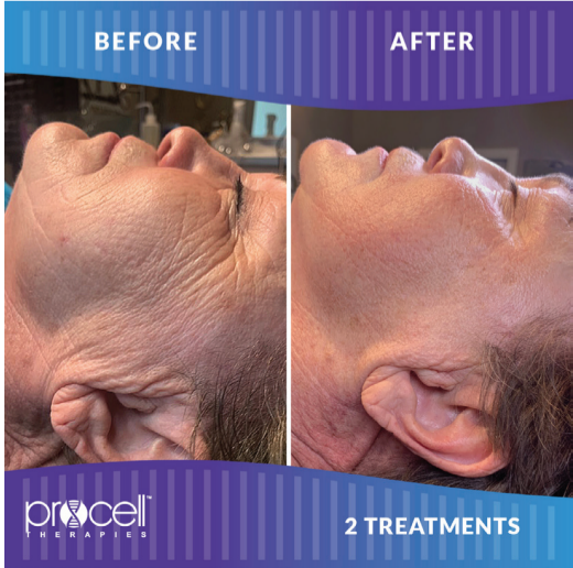 Procell microchanneling treatment in Wayzata, MN promoting firmer, tighter-looking skin.