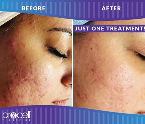 Advanced Procell microchanneling session in Wayzata, Minnesota stimulating collagen for youthful, revitalized skin.