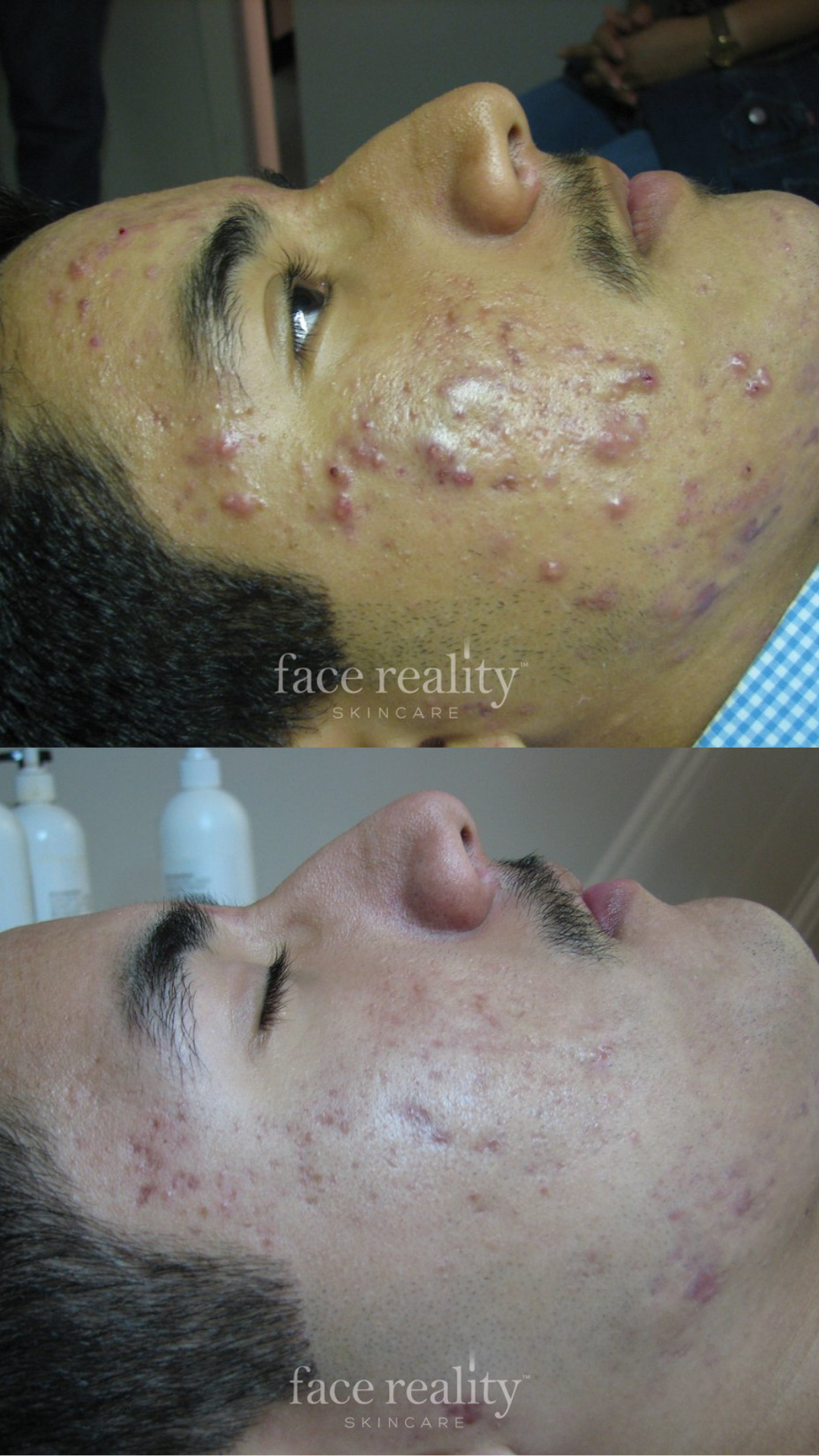 face-reality-acne-before-after-wayzata.jpg