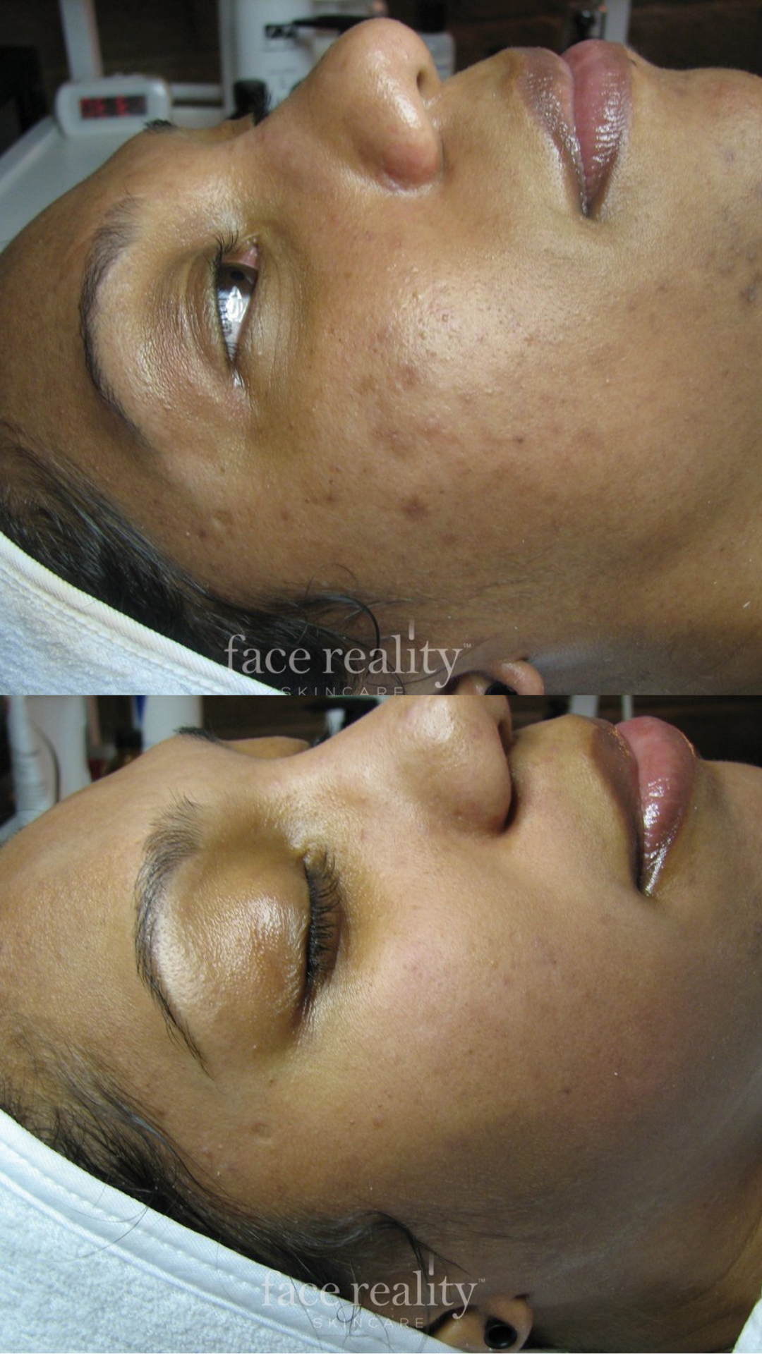 face-reality-acne-before-after-wayzata.jpg