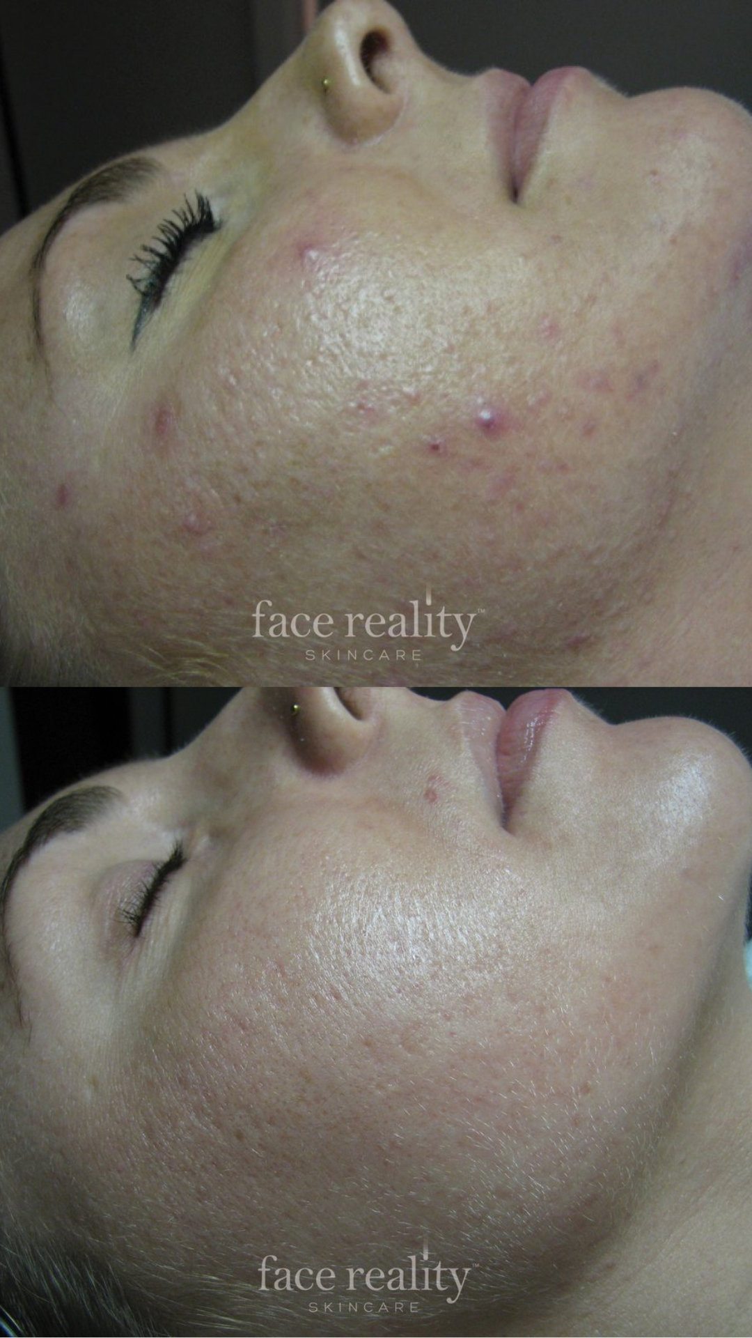 face-reality-acne-before-after-wayzata.jpg