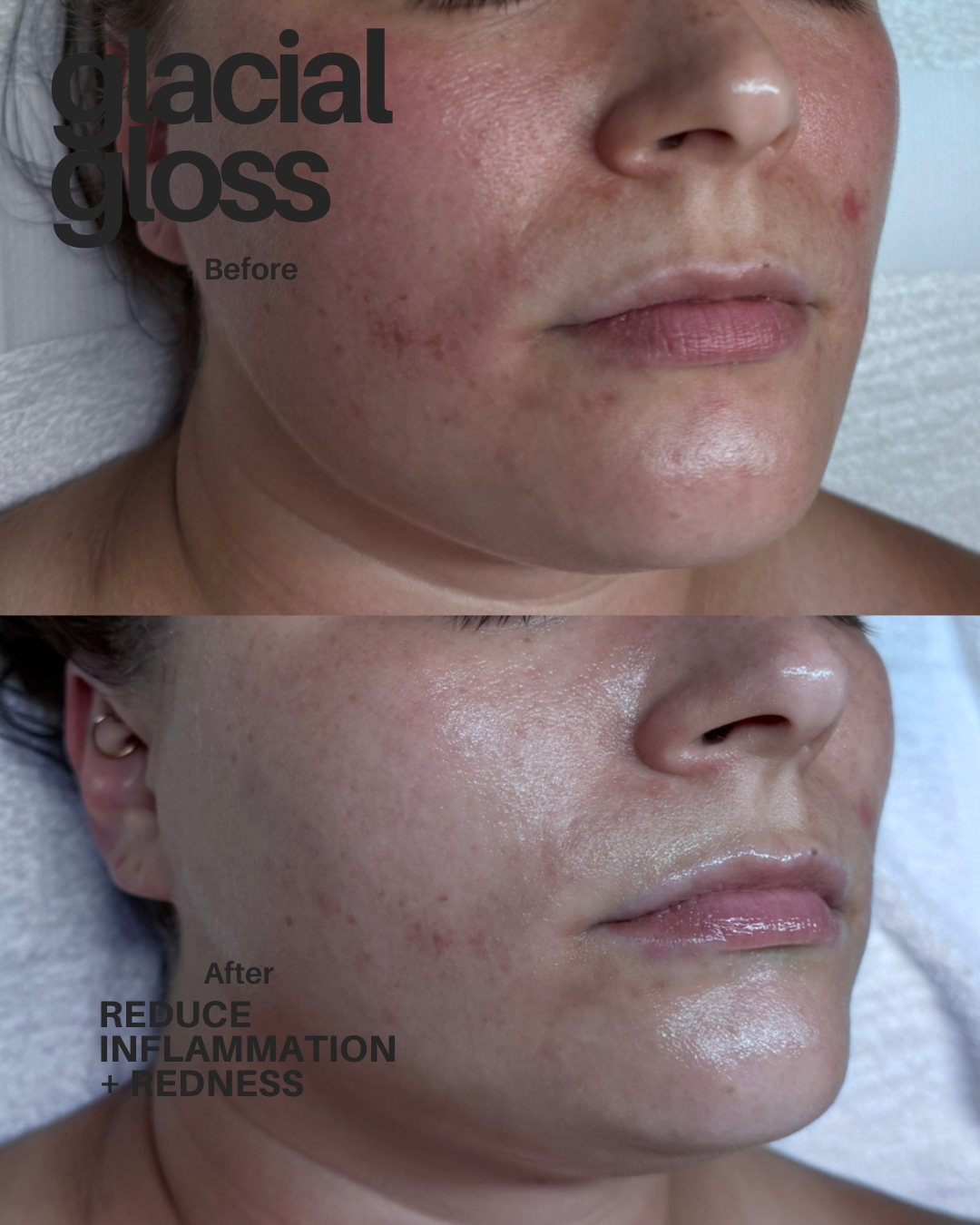 glacial_gloss_facial_before_after_wayzata.png
