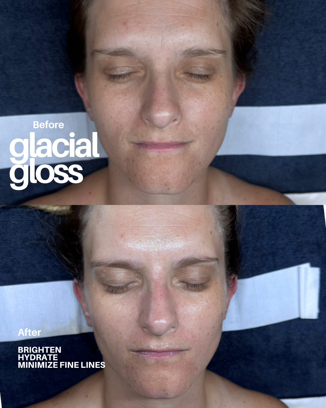 glacial_gloss_facial_cooling_wayzata.png