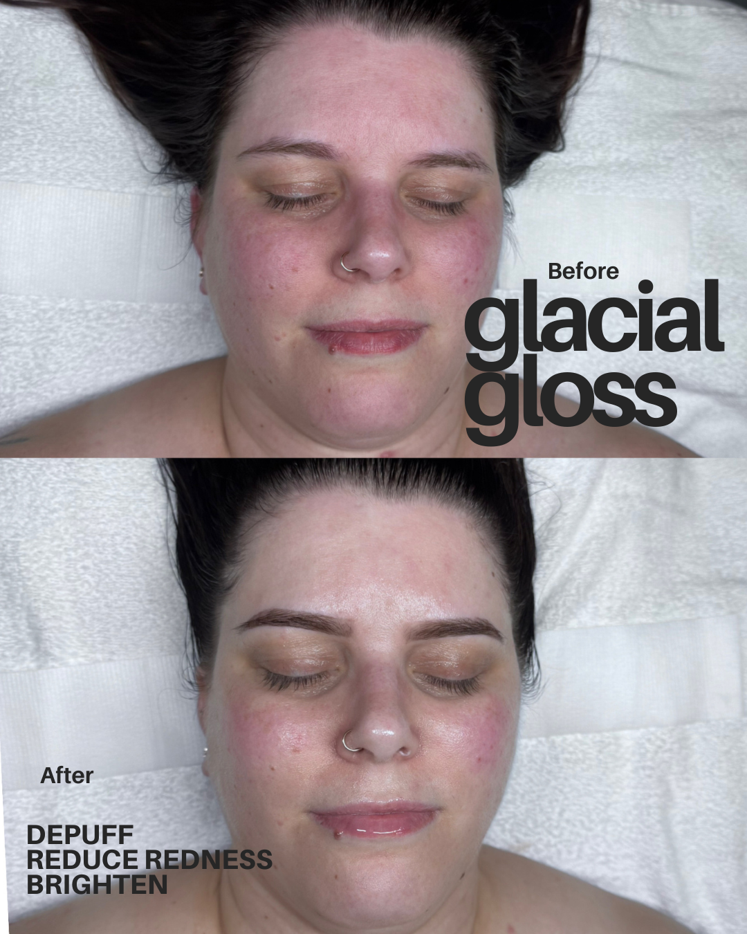 glacial_gloss_Depuffing_cooling_facial.png